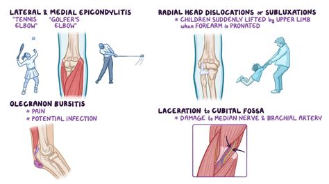 Lateral Epicondylitis