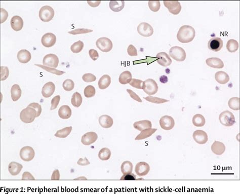 Sickle Cell Blood Smear