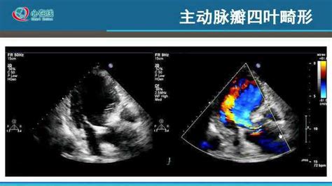 主动脉瓣返流的超声基础知识 高清1080P在线观看平台 腾讯视频