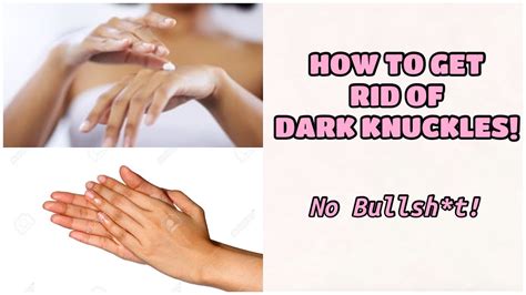 HOW TO GET RID OF DARK KNUCKLES FOREVER YouTube