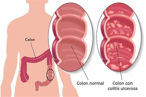 Tratamiento Para El Sindrome De Crohn