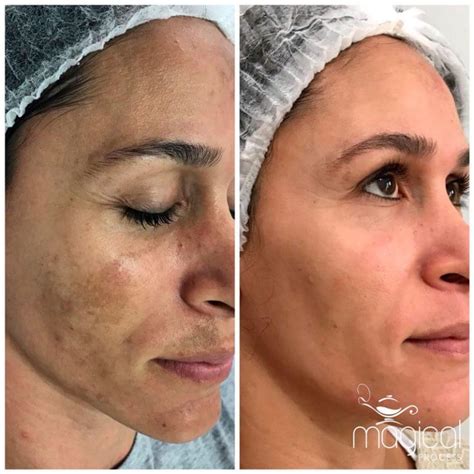 Tratamento Contra O Melasma Magical Process Giuliana Milena