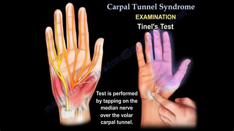 Carpal Tunnel Syndrome And Median Neuropathy Youtube