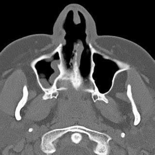 Fig1: CT scan of sinus revealing a thickness in the right maxillary... | Download Scientific Diagram