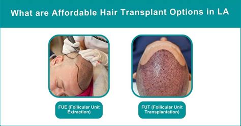 How Much Does a Hair Transplant Cost in LA and Why?