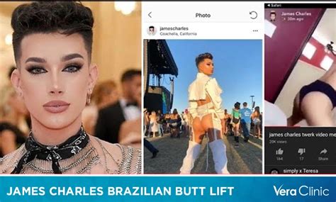 James Charles Brazilian Butt Lift Exploring The Controversy