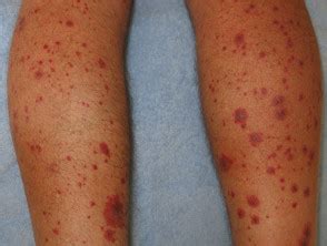 Vasculitis cutánea de vasos pequeños Dermatly El sitio de tu piel