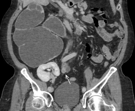 Urinary tract obstruction | Radiology Key