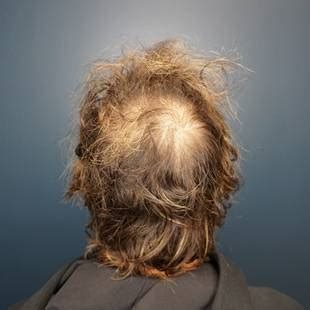 Hair Restoration Before & After Photos - Precision Calgary