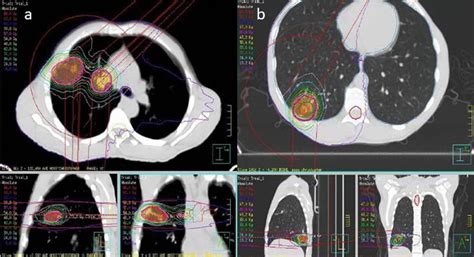 Computed Tomography Planning Scan And Isodose Lines Representing