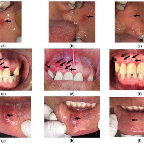 RU Is Located In Different Parts Of The Oral Cavity Indicated With