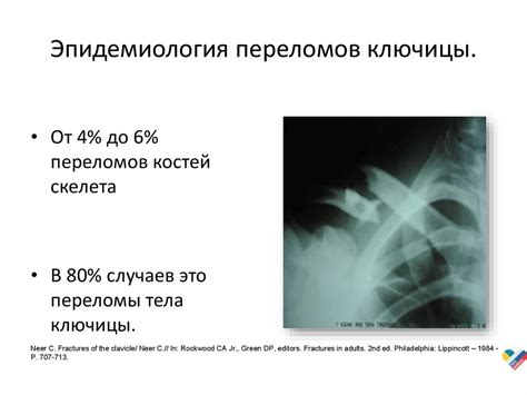 Переломы ключицы - online presentation