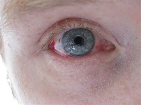 Stitches Visible Day 11 After Corneal Transplant Ja… Flickr