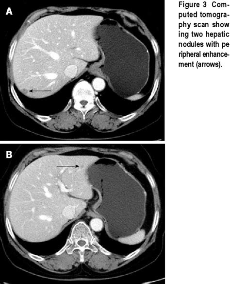 Figure 3 From Tertiary Syphilis Mimicking Hepatic Metastases Of