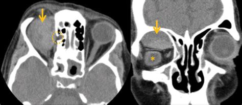 Subperiosteal Orbital Hematoma An Uncommon Complication Of Acute