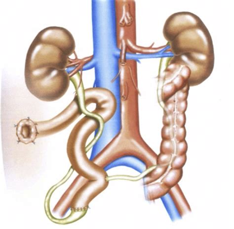 Laparoscopic Management Of Ureteroileal Anastomosis Strictures Initial