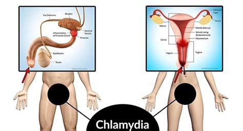 علائم عوارض و راههای درمان عفونت کلامیدیا Hi Teb هایطب
