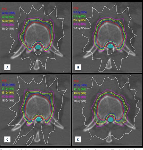 Figure From Dose Evaluation Of Fractionated Schema And Distance From