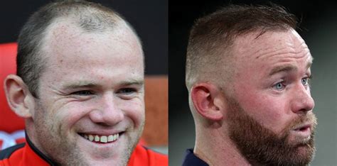 Wayne Rooney's Hair Transplant Journey - BlueMagic Group