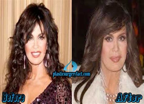 Marie Osmond Plastic Surgery Before and After - Plastic Surgery Facts