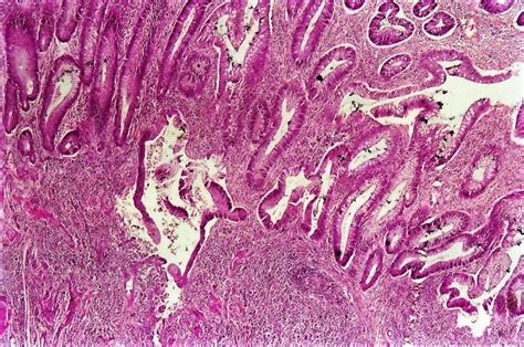 Colon Tumor Inflammatory Polyp Of Colon