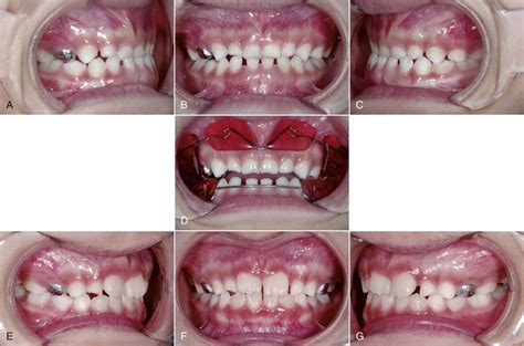 14 Treatment Strategies For Developing And Nondeveloping Class Iii Malocclusions Pocket Dentistry