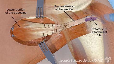 Massive Irreparable Rotator Cuff Tears The Shoulder And Elbow Clinic