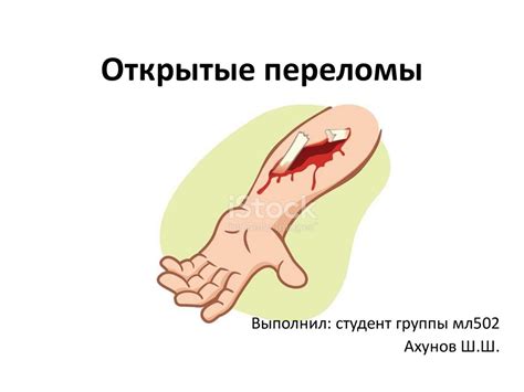 Открытые переломы - презентация онлайн