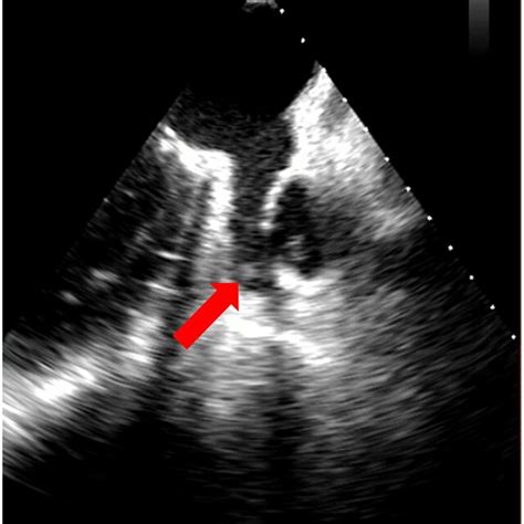 Left atrial appendage thrombus indicated with a red arrow on TEE (Heart ...