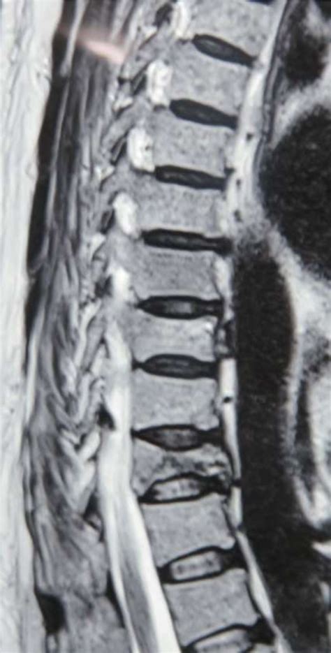 Figure 1 From Multiple Myeloma IgA With Spinal Vertebral Collapse And