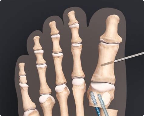 Arthrex Bunionectomy Minimally Invasive Bunion Correction