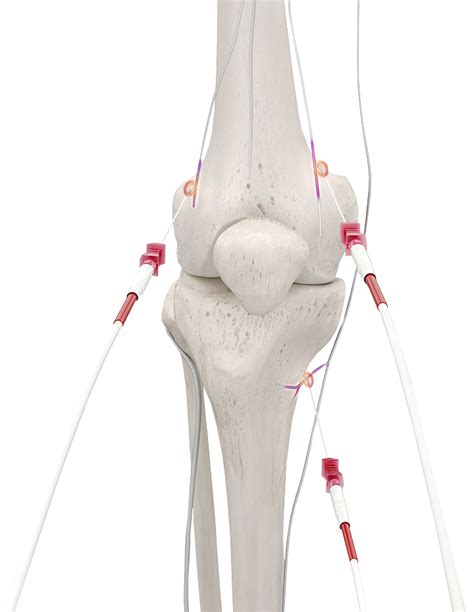 Genicular Radiofrequency Ablation Interventional Spine