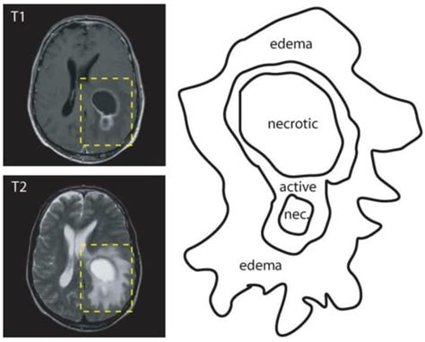 J Imaging Free Full Text Deep Learning For Brain Tumor