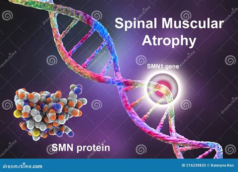 Spinal Muscular Atrophy Sma A Genetic Neuromuscular Disorder With