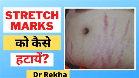 Stretch Marks Causes And Treatment स्ट्रेच मार्क्स को ठीक कैसे करें