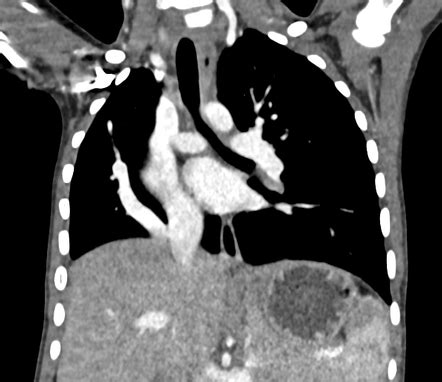 Radiology Quiz 174689 Radiopaedia Org