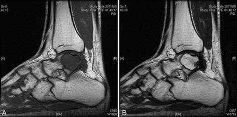 Intraosseous Gouty Tophus In The Talus A Case Report The Journal Of