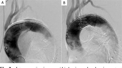 Figure 2 From Use Of A Stent Graft For Patent Ductus Arteriosus In An Octogenarian Eliminates