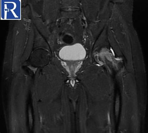 Transient Osteoporosis Of Hip