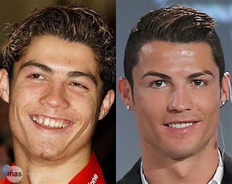Famosos Com Lente De Contato Nos Dentes Antes E Depois - Veja Aqui o Sorriso Dos Famosos que Fizeram Lente De Contato Dental ...