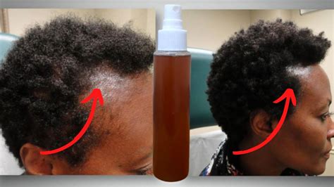 How To Use Clove Water Properly For Unstoppable Hair Growth Hair