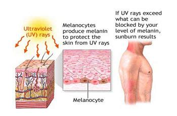 Sunburn Uv Overexposure Skin Cancer