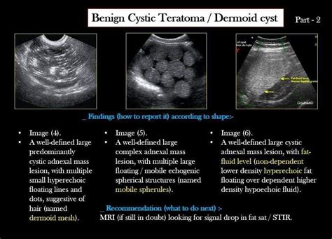 Apa Itu Dermoid Cyst Sydneekruwdavenport