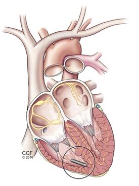 Leadless Pacemaker