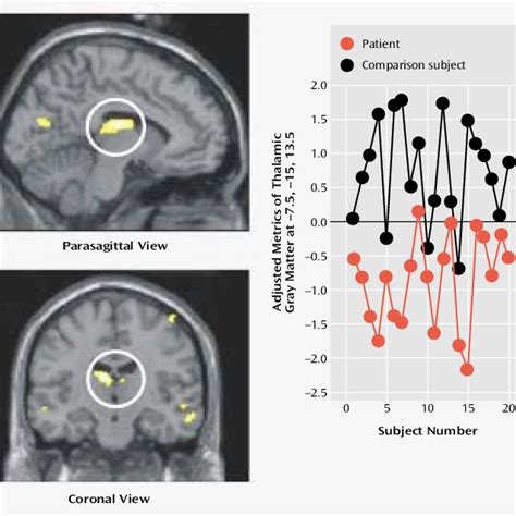 Cortical And Subcortical Regions Of Corrected Gray Matter Differences