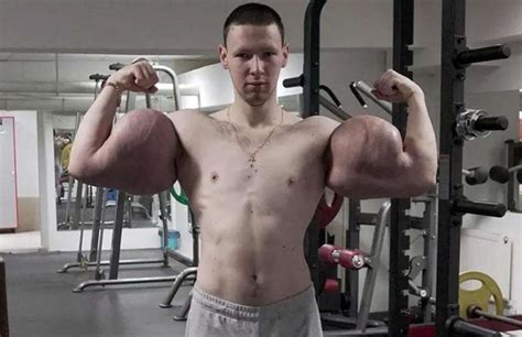 Russian 'Popeye' Has Life-Saving Surgery to Remove Chemicals from His Biceps - Plastic Surgery ...