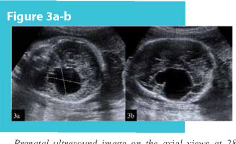 Arachnoid Cyst Ultrasound