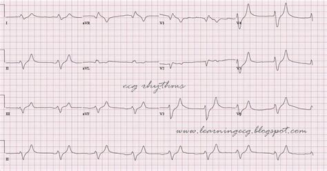 ECG Rhythms: Hyperkalemia