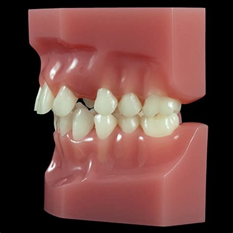 Or 17m Mixed Dentitionclass Ii Division 1 Blocked Cuspid Flexibase Paradigm Dental Models