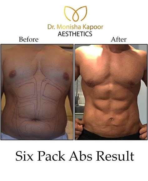 Abdominal Etching Takes Liposuction To The Next Level As It Involves An